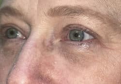 Upper/Lower Lid Blepharoplasty