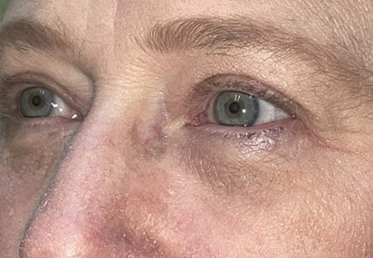 Upper/Lower Lid Blepharoplasty