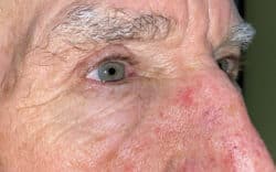 Eyelid Lift (Blepharoplasty/Ptosis Repair)