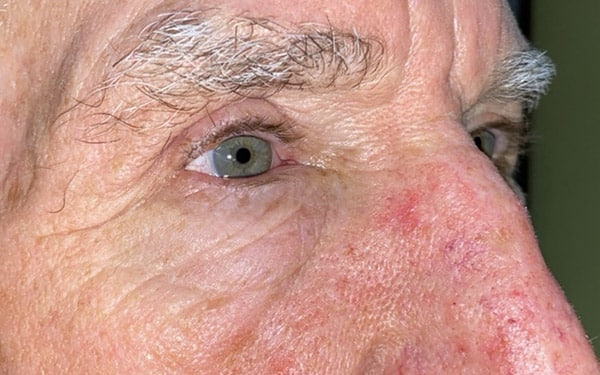 Eyelid Lift (Blepharoplasty/Ptosis Repair)