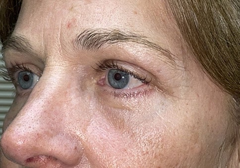 Brow/Forehead Lift