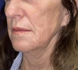 CO2 Laser Resurfacing (wrinkle/line reduction)