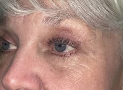 Combination Surgeries (eyelid lift and other)