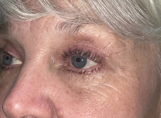 Combination Surgeries (eyelid lift and other)