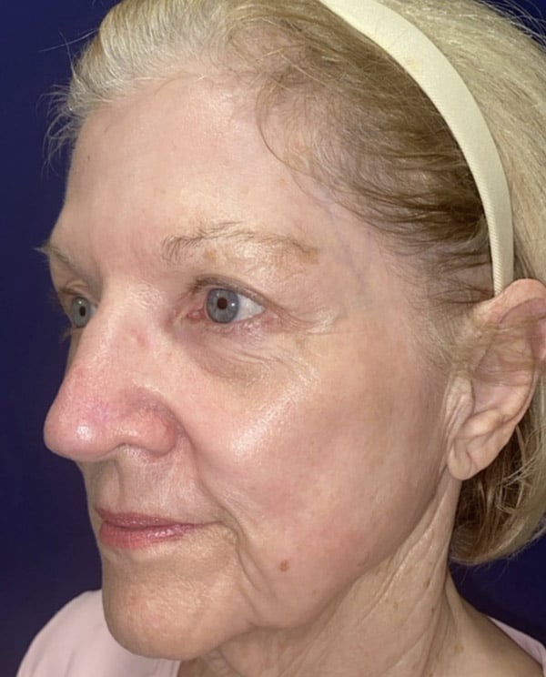 Combination Surgeries (eyelid lift and other)