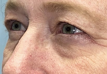 Upper/Lower Lid Blepharoplasty
