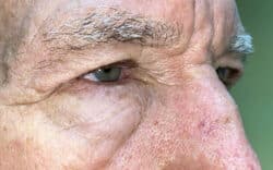 Eyelid Lift (Blepharoplasty/Ptosis Repair)