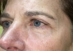 Brow/Forehead Lift