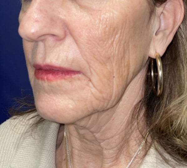 CO2 Laser Resurfacing (wrinkle/line reduction)
