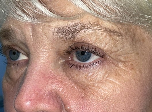 Combination Surgeries (eyelid lift and other)
