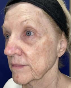 Combination Surgeries (eyelid lift and other)