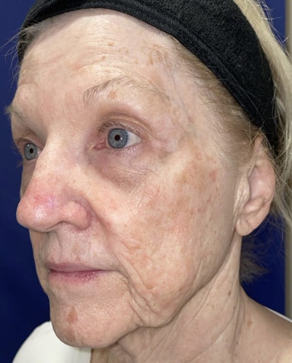 Combination Surgeries (eyelid lift and other)