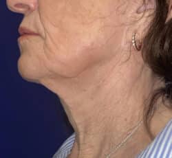 CO2 Laser Resurfacing (wrinkle/line reduction)
