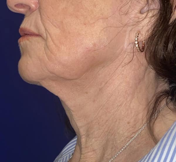 CO2 Laser Resurfacing (wrinkle/line reduction)