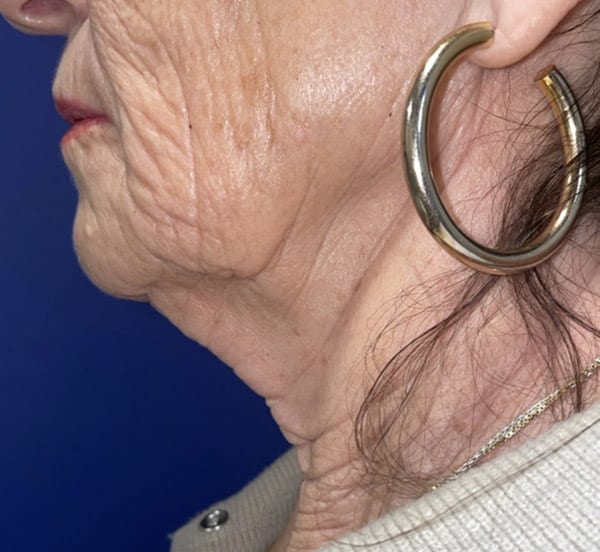 CO2 Laser Resurfacing (wrinkle/line reduction)