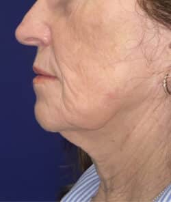 CO2 Laser Resurfacing (wrinkle/line reduction)