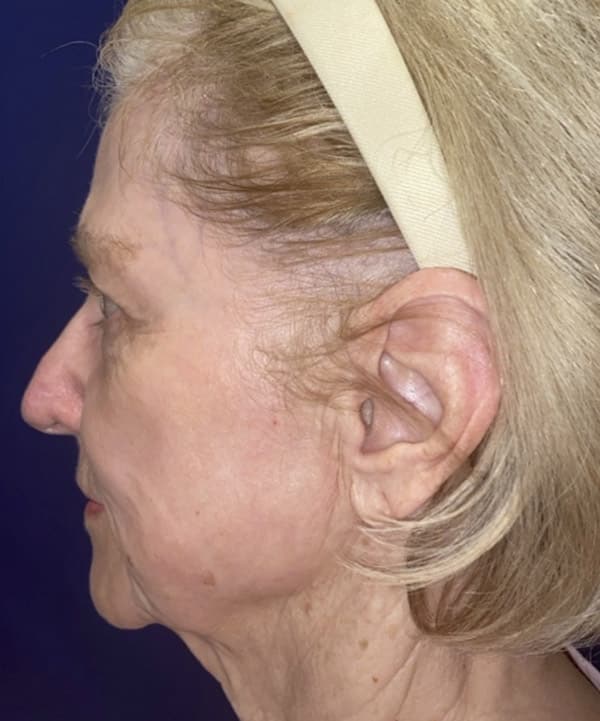 Combination Surgeries (eyelid lift and other)