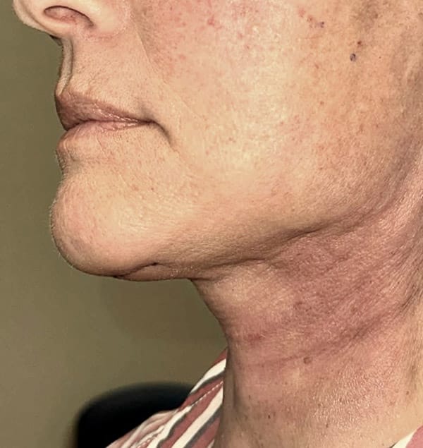 Face/Neck Lift