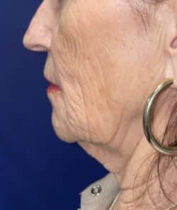 CO2 Laser Resurfacing (wrinkle/line reduction)