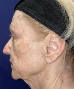 Combination Surgeries (eyelid lift and other)