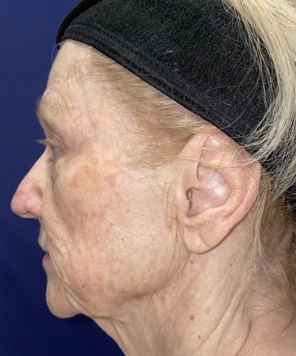 Combination Surgeries (eyelid lift and other)