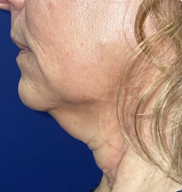 Face/Neck Lift