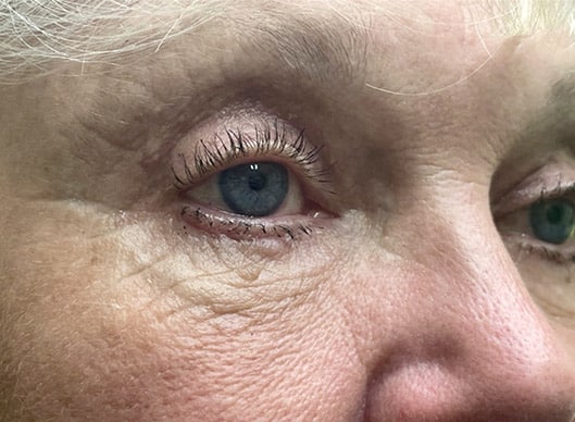 Combination Surgeries (eyelid lift and other)