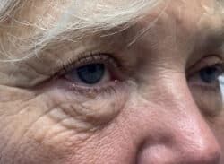 Combination Surgeries (eyelid lift and other)