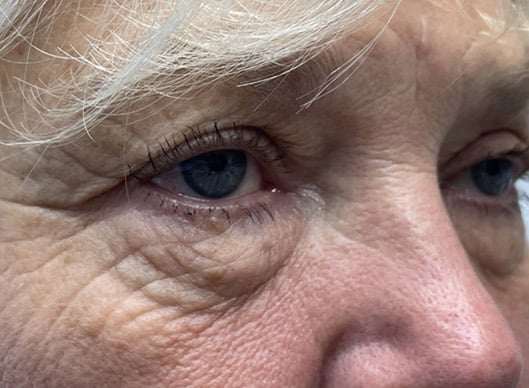 Combination Surgeries (eyelid lift and other)