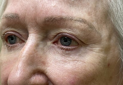 Lower Lid Blepharoplasty (lower eyelid eyelift)