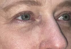 Upper/Lower Lid Blepharoplasty