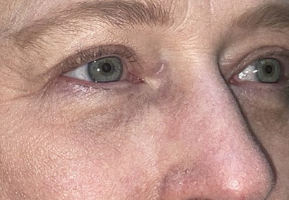 Upper/Lower Lid Blepharoplasty
