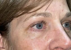 Brow/Forehead Lift