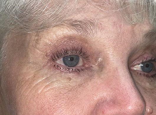 Combination Surgeries (eyelid lift and other)