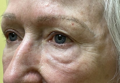 Lower Lid Blepharoplasty (lower eyelid eyelift)