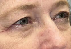 Upper/Lower Lid Blepharoplasty
