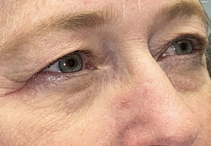 Upper/Lower Lid Blepharoplasty