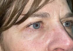 Brow/Forehead Lift