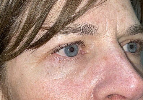 Brow/Forehead Lift