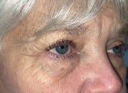 Combination Surgeries (eyelid lift and other)