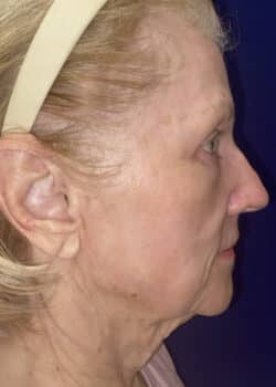 Combination Surgeries (eyelid lift and other)