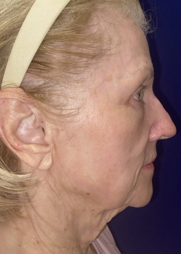 Combination Surgeries (eyelid lift and other)