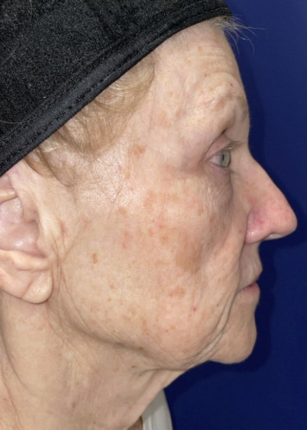 Combination Surgeries (eyelid lift and other)