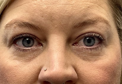 Upper/Lower Lid Blepharoplasty