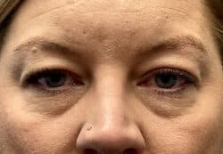 Upper/Lower Lid Blepharoplasty