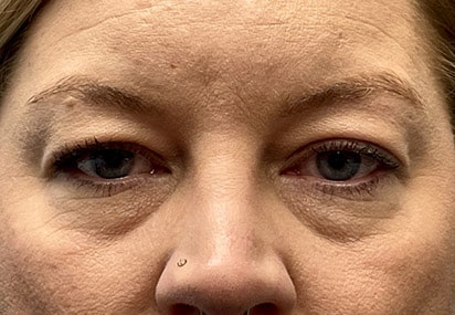 Upper/Lower Lid Blepharoplasty
