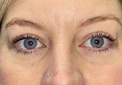 Upper/Lower Lid Blepharoplasty