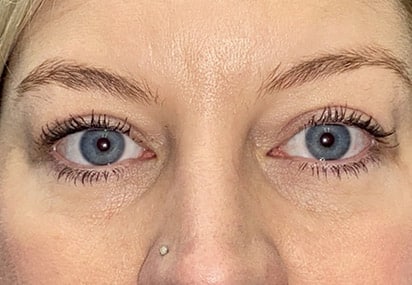 Upper/Lower Lid Blepharoplasty