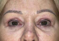 Upper/Lower Lid Blepharoplasty