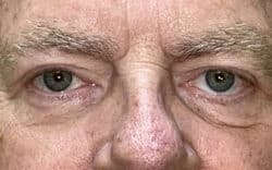 Eyelid Lift (Blepharoplasty/Ptosis Repair)